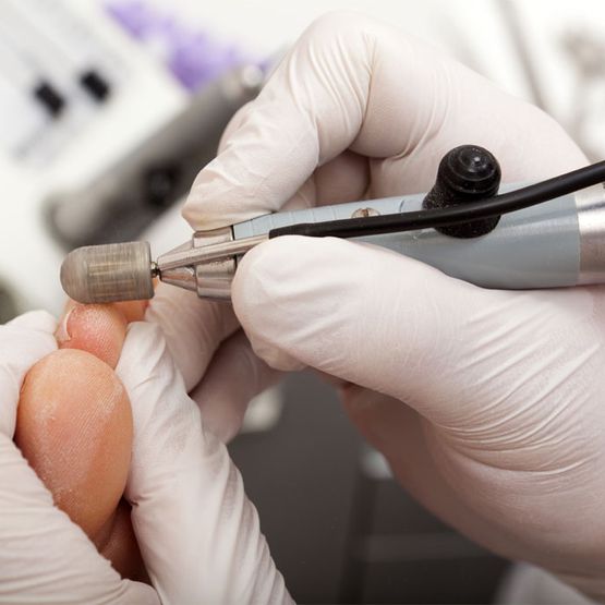 Fisiosalut Alzira limación de uñas
