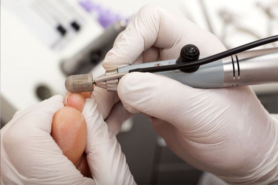 Fisiosalut Alzira limación de uñas